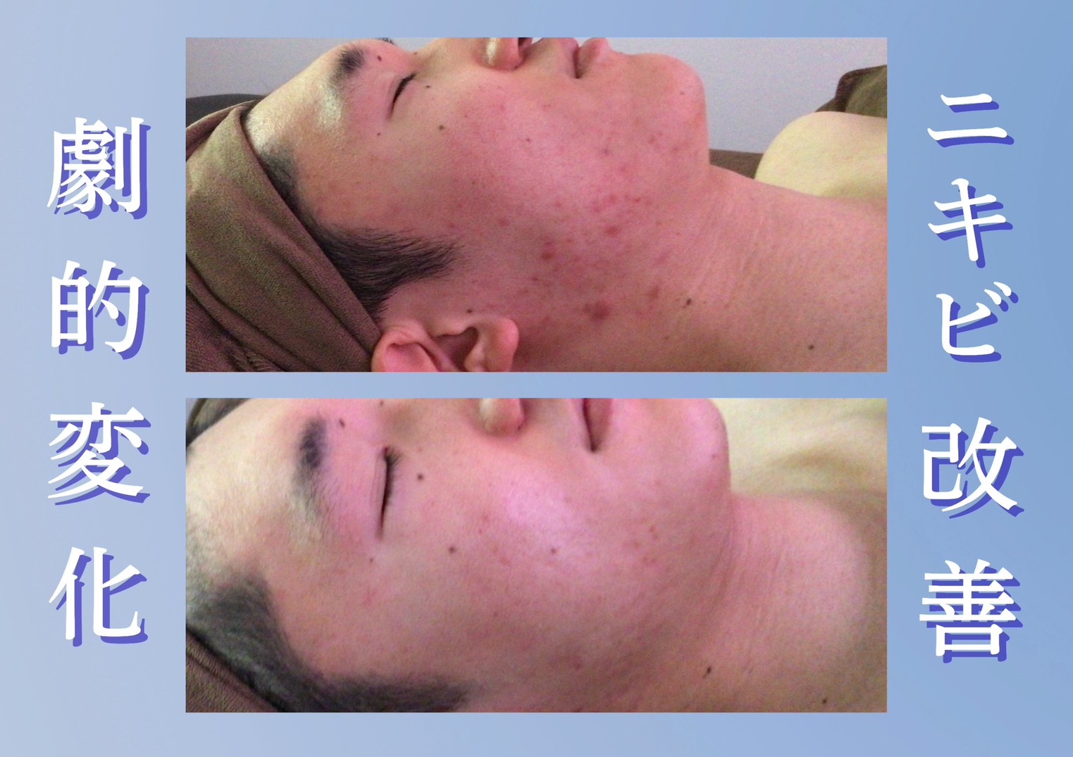 ニキビ跡の改善 施術前後