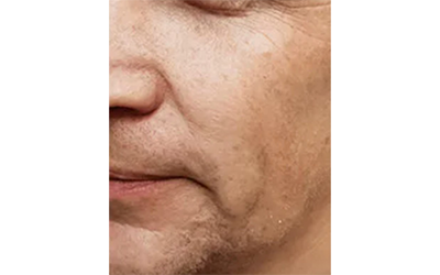 超音波×ピーリング贅沢ケア